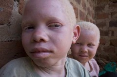Albinos Tanzanie.jpg