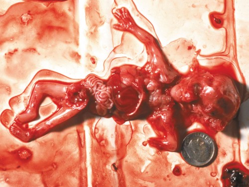 Foetus avorté de 10 semaines.jpg